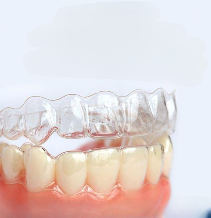 Clear Aligners